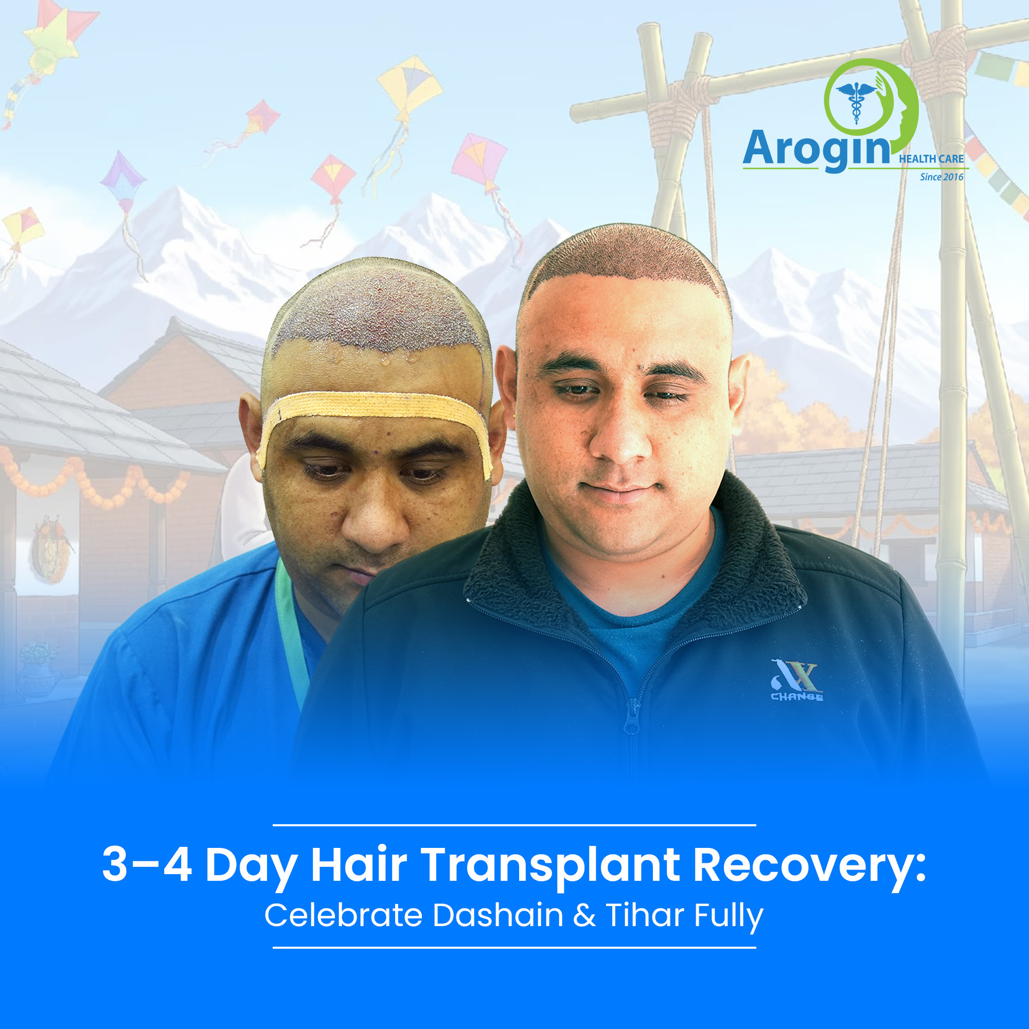 3–4 Day Hair Transplant Recovery: Celebrate Dashain & Tihar Fully
